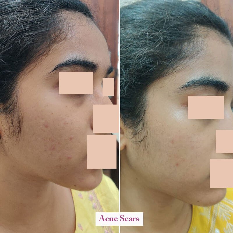 acne scars 1