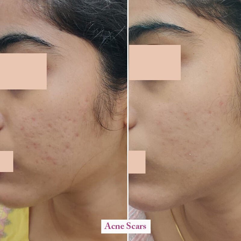 acne scars 3