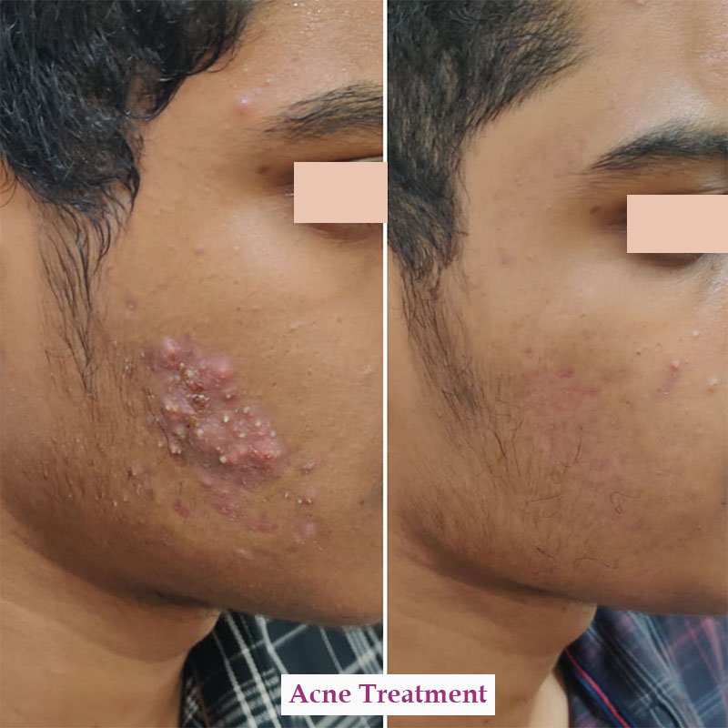 acne treatment 5