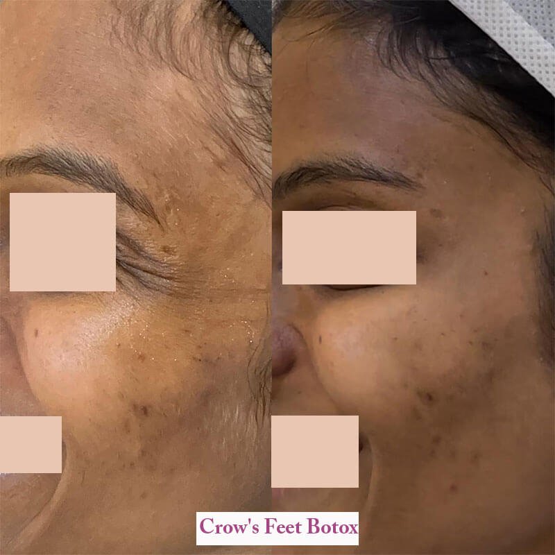 crows feet botox