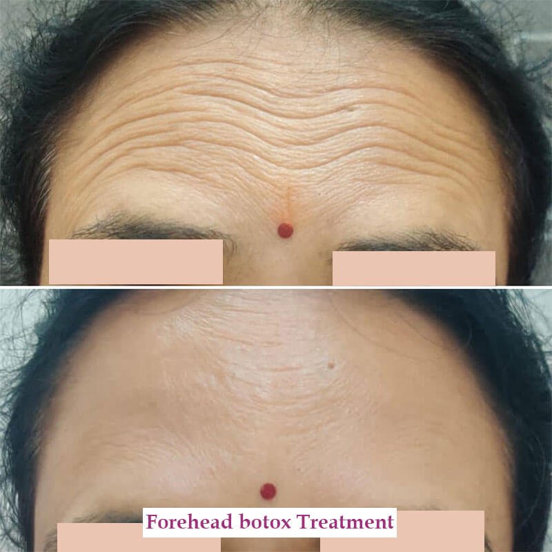 forehead botox treatment