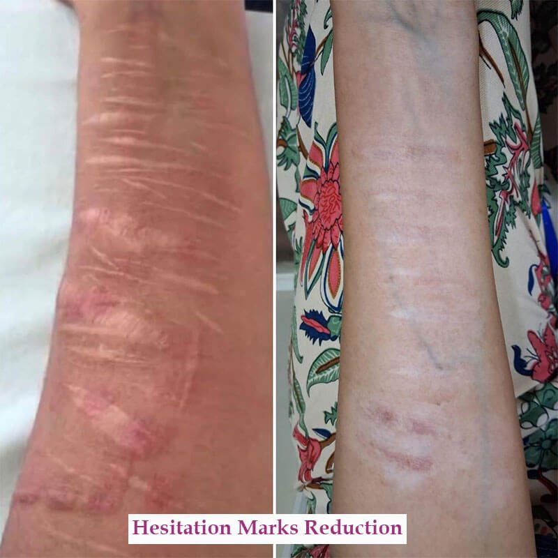 hesitation marks reduction