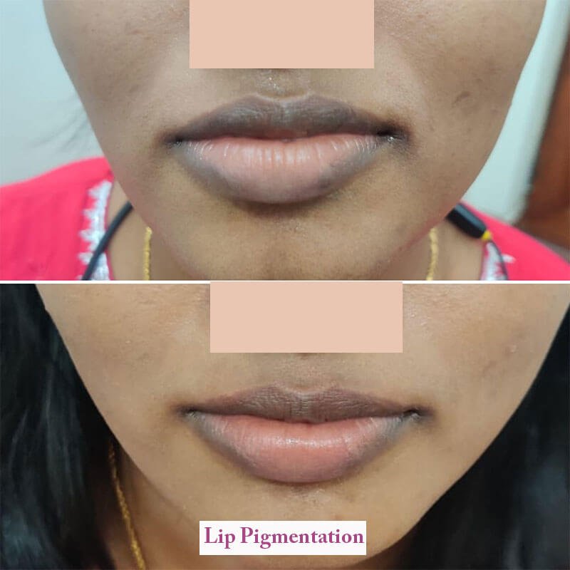 lip pigmentation