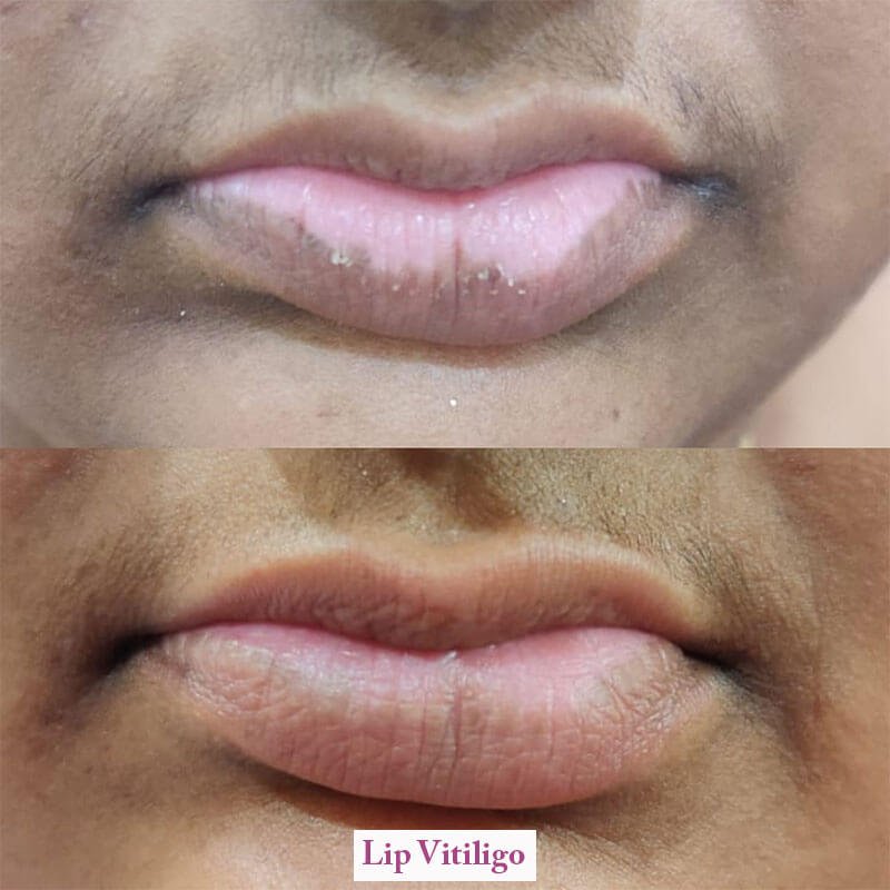 lip vitiligo